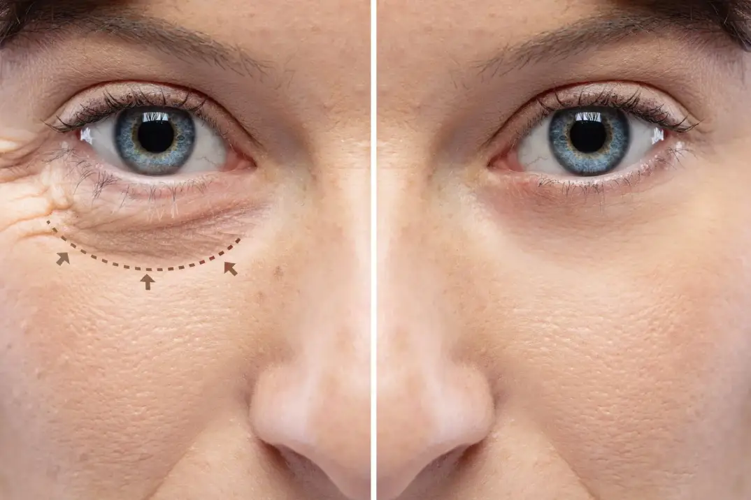 Blepharoplasty surgery risks and benefits graphic