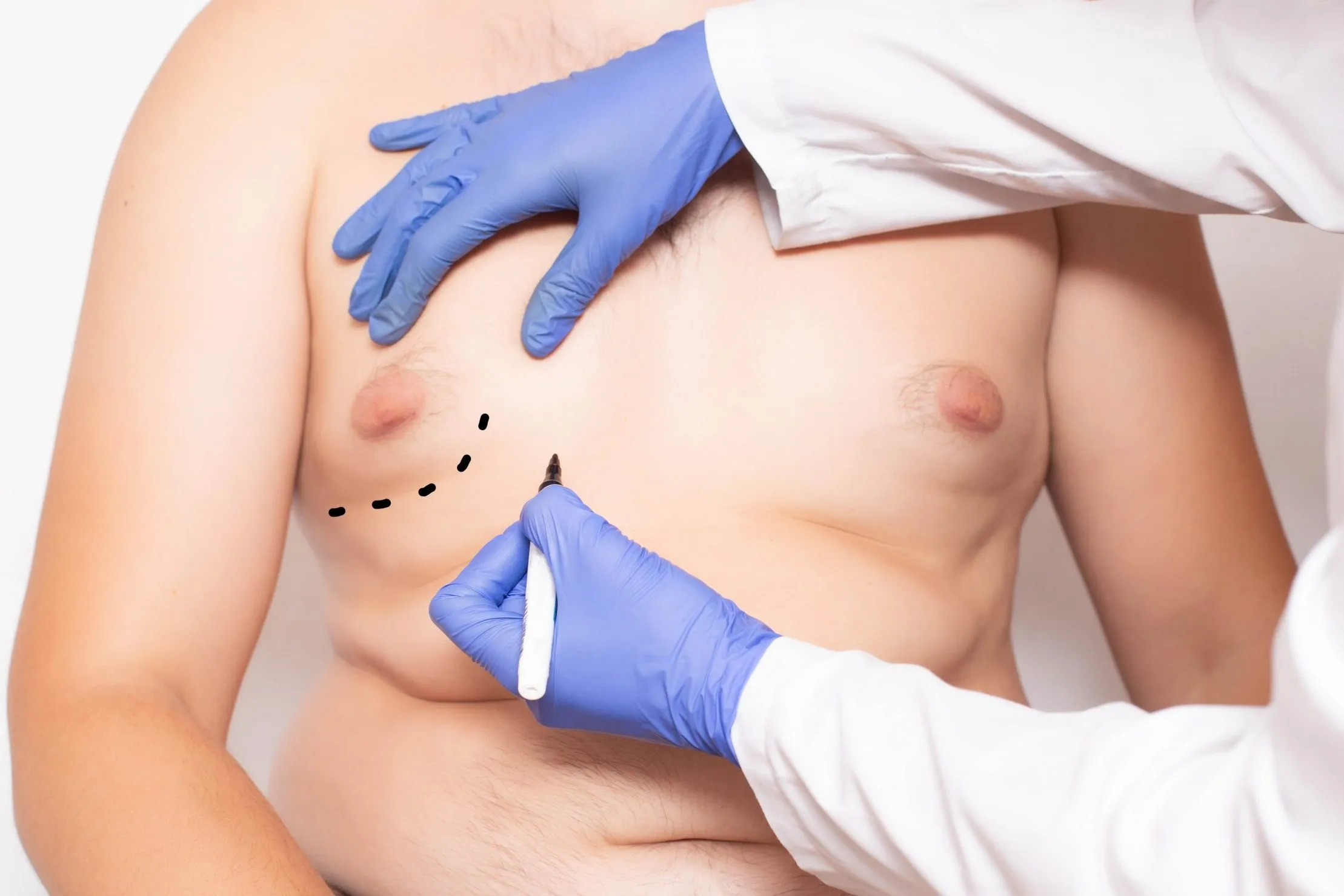 results of male gynecomastia surgery