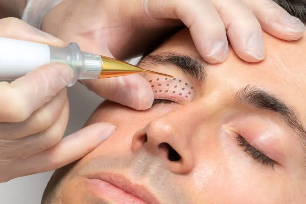 Plasma Pen skin tightening for wrinkles and fine lines