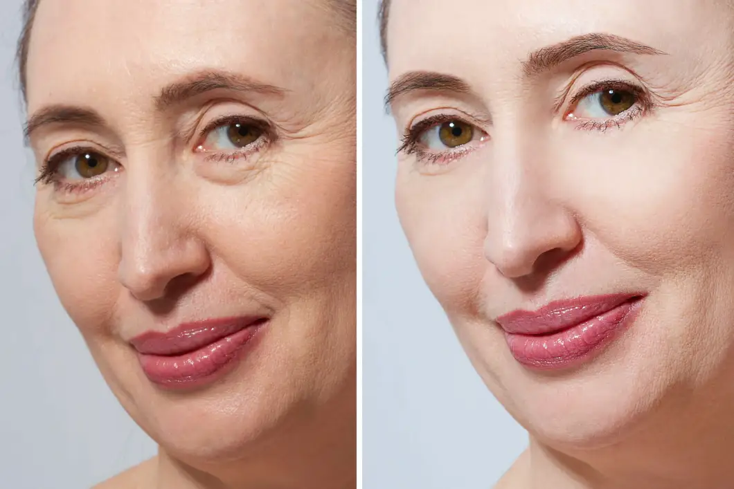 Facelift procedure overview patient graphic