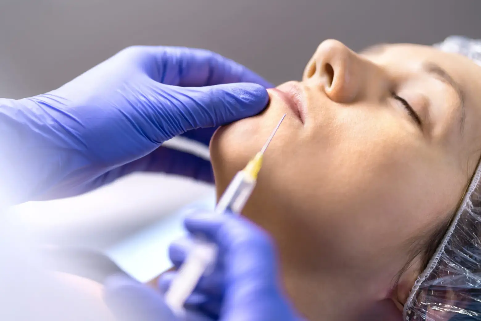 Dermal filler longevity patient treatment image