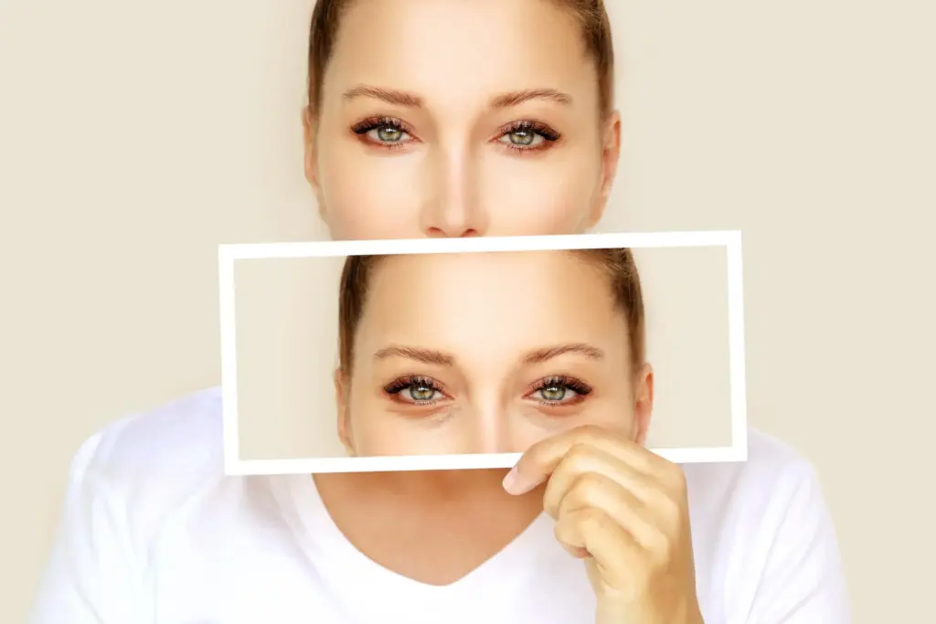 Upper and lower eyelid surgery for eye rejuvenation