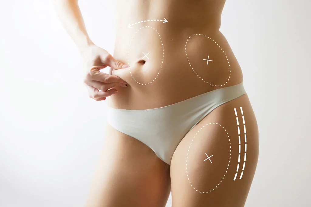 Abdominoplasty tummy tuck in Bismarck ND