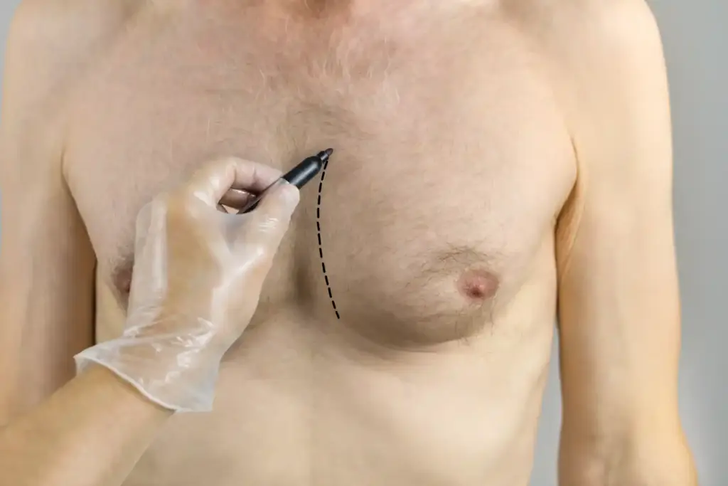 Male breast reduction at The Aesthetic Center